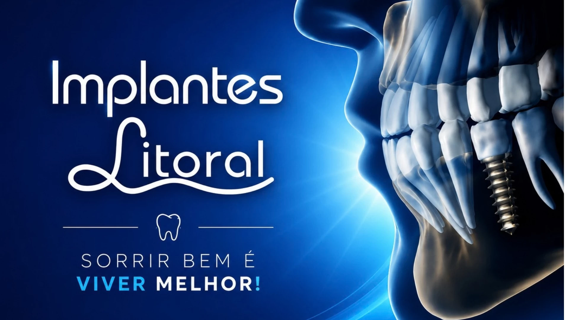 Implantes Litoral